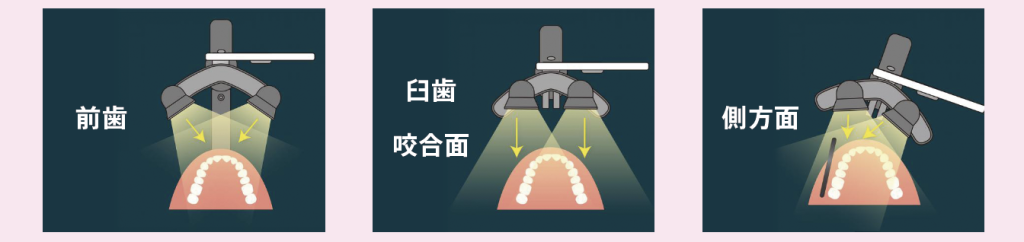 口腔内撮影を楽にできる便利なライト「LAMP・U」│歯科医院ロケット